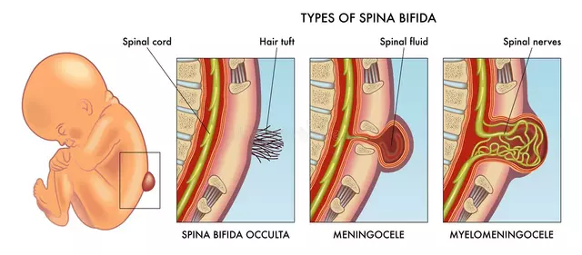 Le rôle des soins orthopédiques dans la gestion des complications de la spina bifida